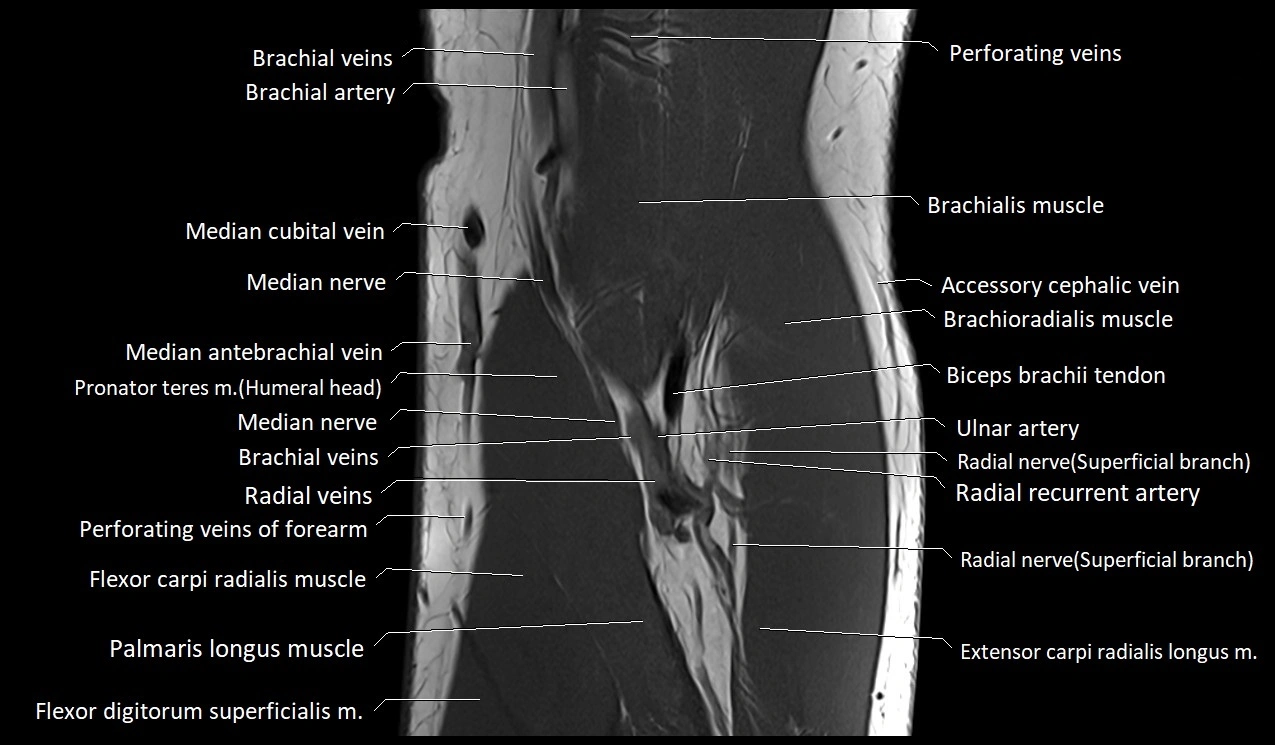 Elbow coronal anatomy image  cross sectional 3T MRI image 10.webp